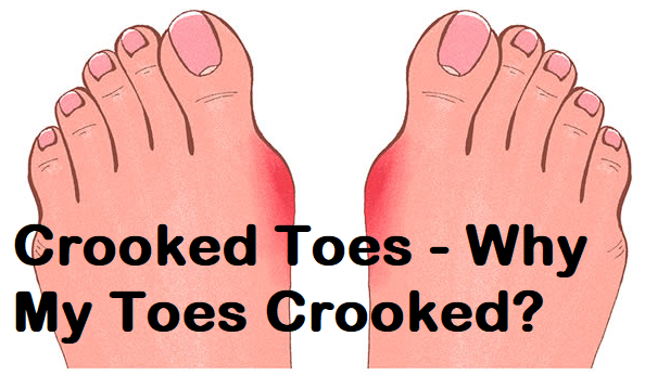 Crooked Toes - Why My Toes Crooked