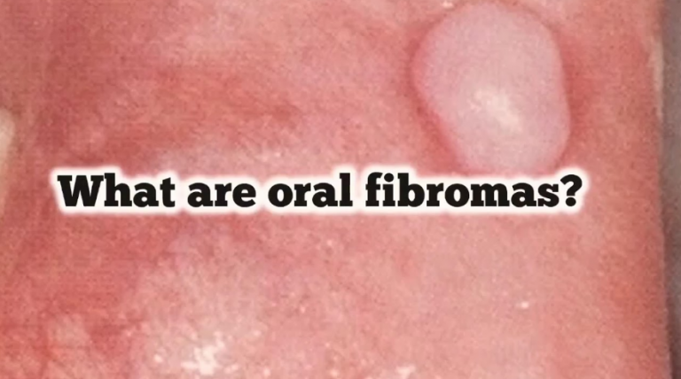 What if I have Oral Fibroma? Symptoms & Treatment - Health WeighUP
