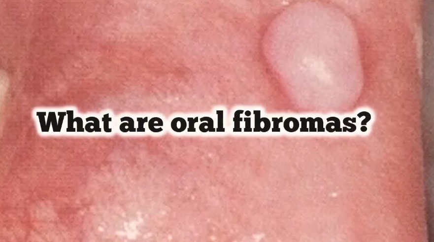 Oral Fibroma