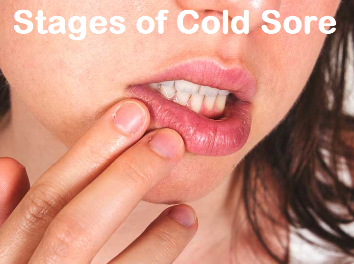 Stages of Cold Sore