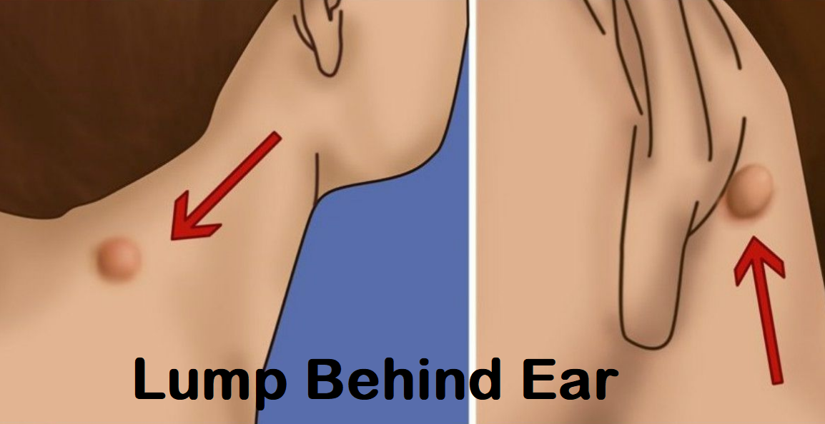 lump behind ear